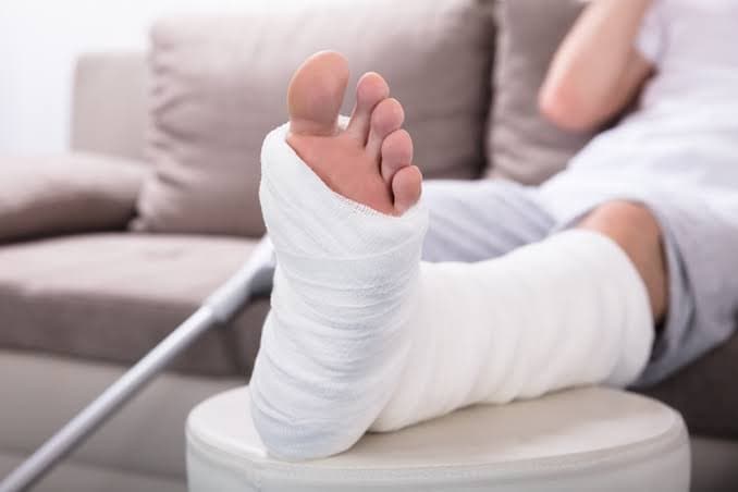 Illustrative photograph of a lower leg supported in a cast