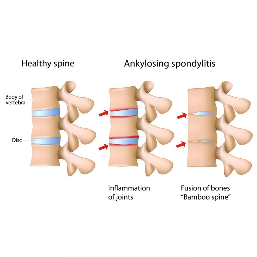 Illustration comparing a healthy spine with ankylosing spondylitis