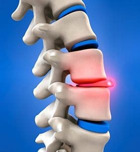 Medical illustration of a lumbar disc protruding near the spine